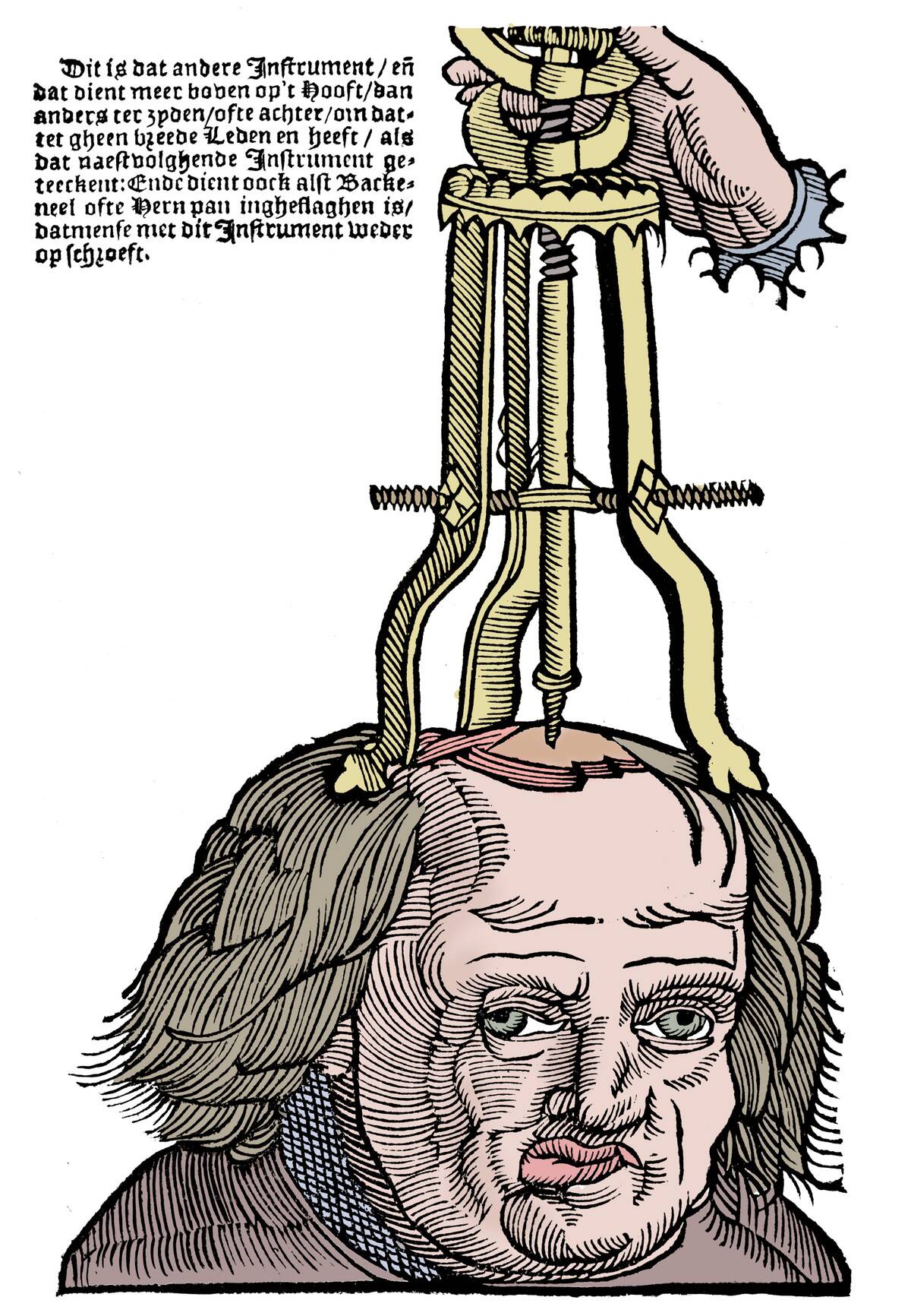 Trephination 1593