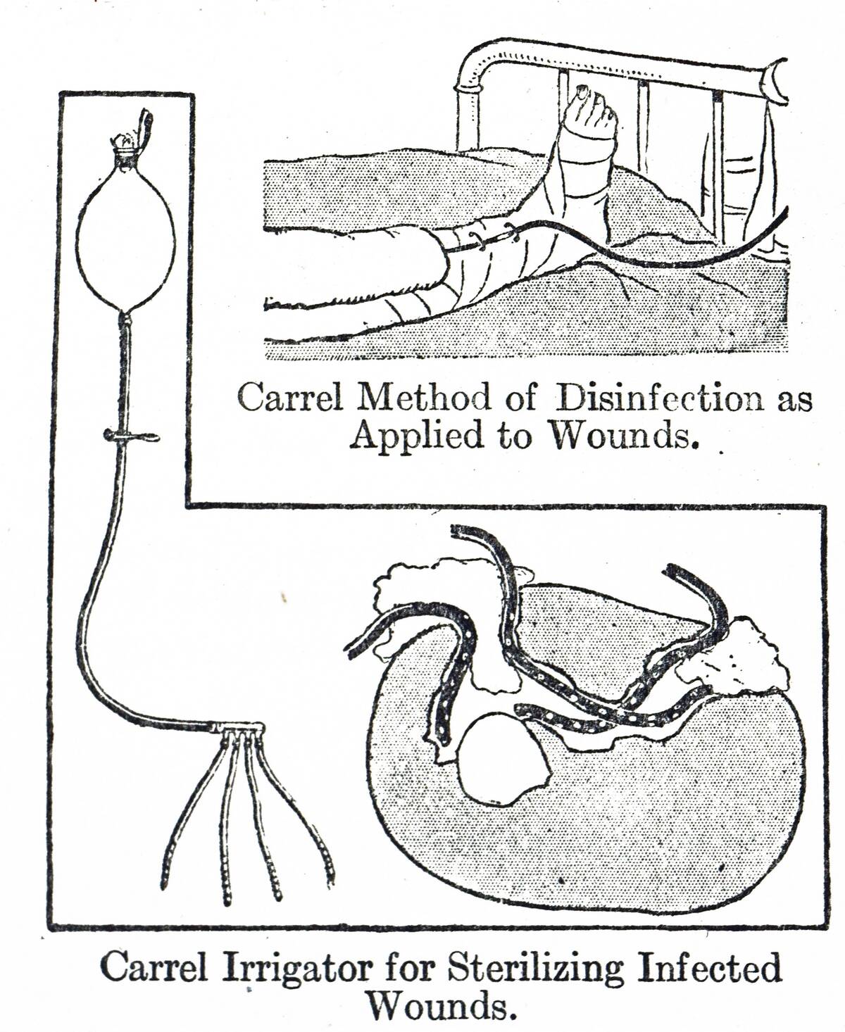 Method of sterilising wounds using Dakin's sodium hypochlorite 0