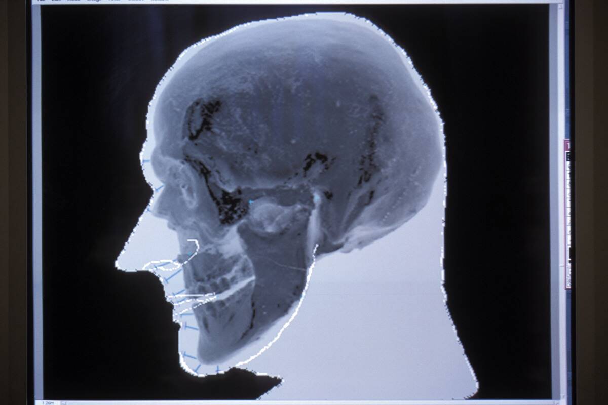 FRA: Otzi The Iceman