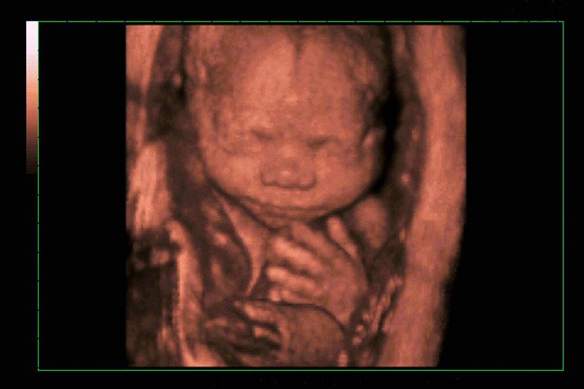 Fetus, 3D Sonography