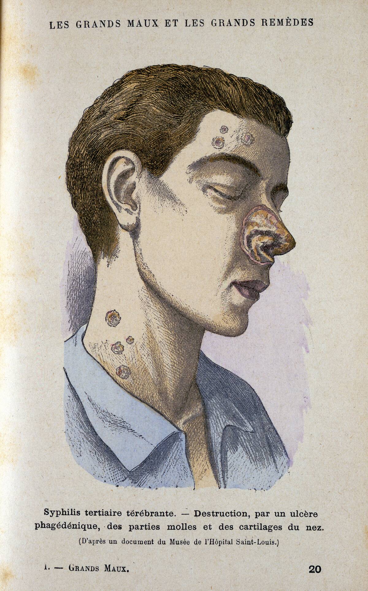 Symptoms of the tertiary phase of syphilis, c19th century.