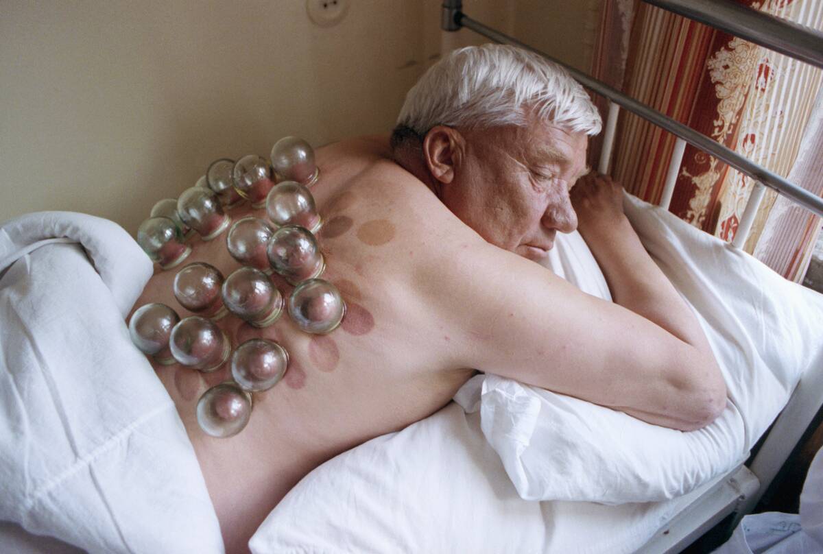 Bronchitis Patient with Glass Bubbles Attached to His Back