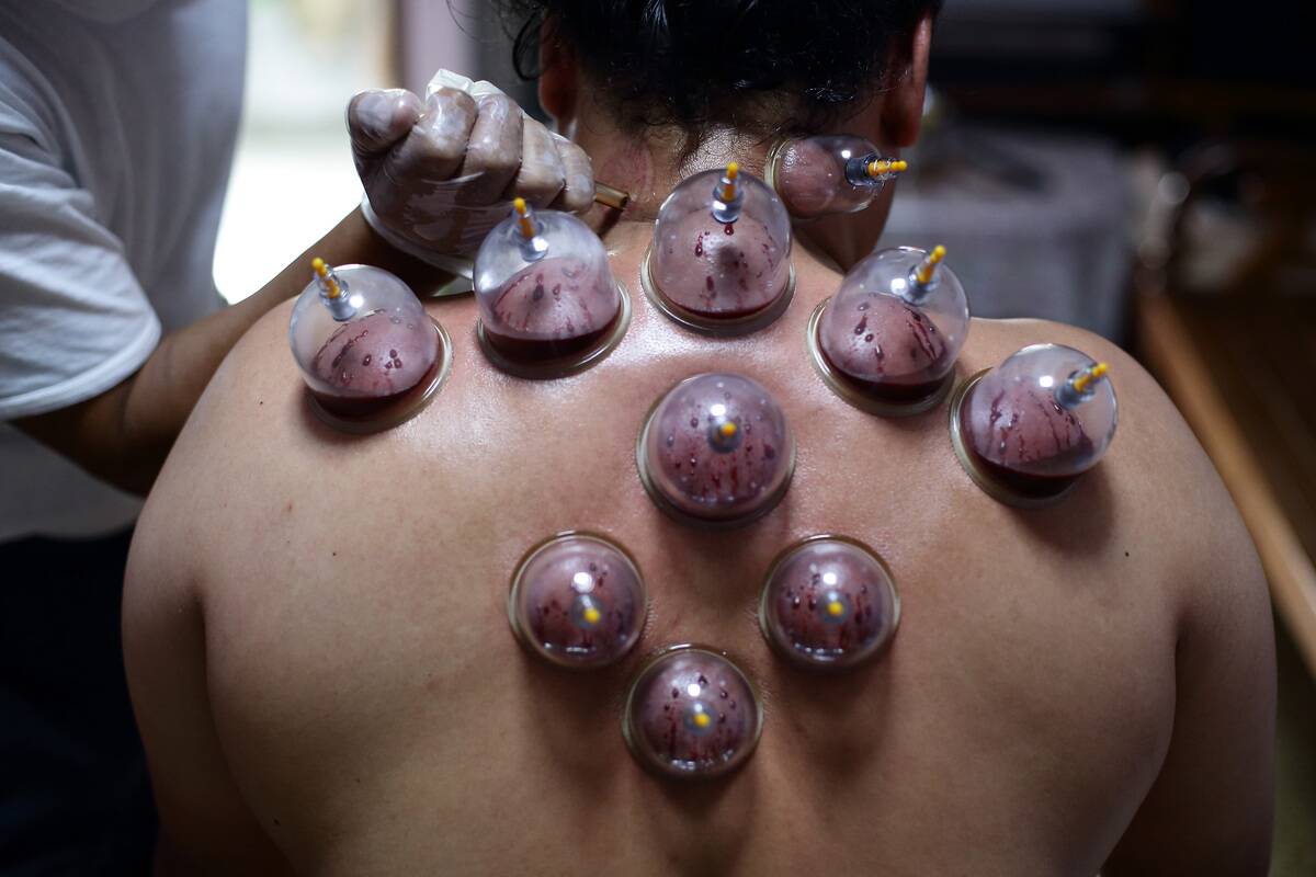 Cupping Therapy Practised In Singapore