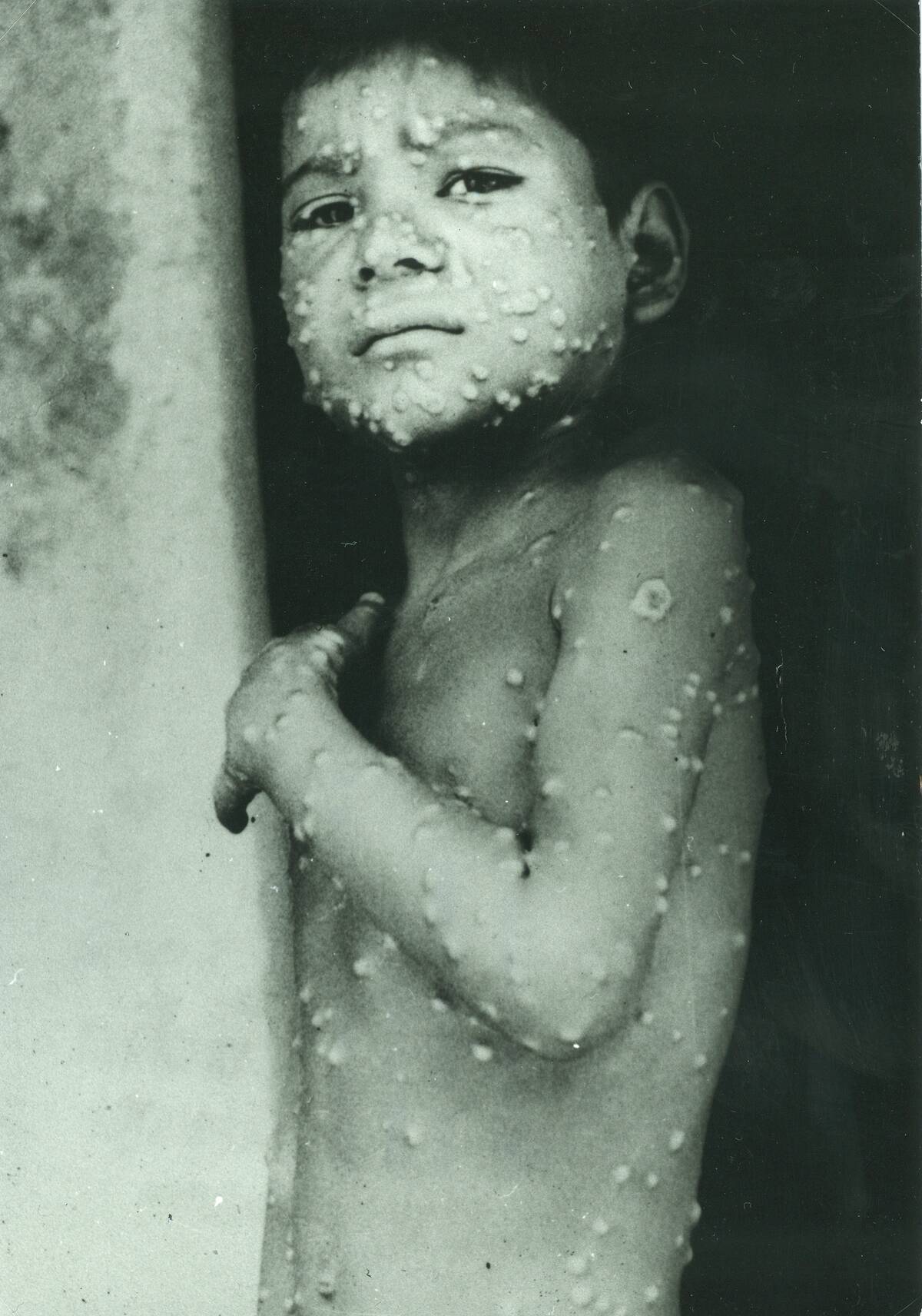 Last indigenous case of Smallpox in India, Katihar District, Eihar State. Victim, Manjo a 7 year old boy, May 1975. WHO photograph.