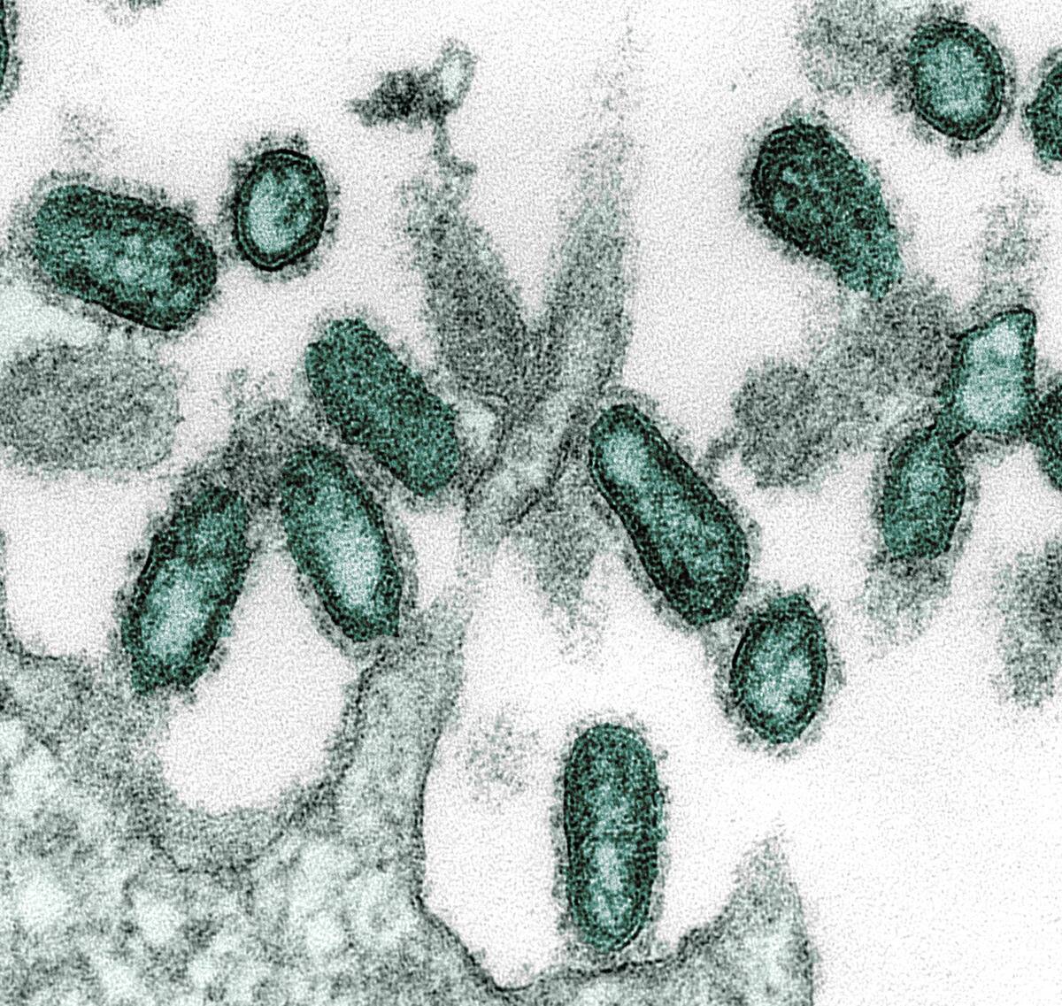 Spanish Flu Infection