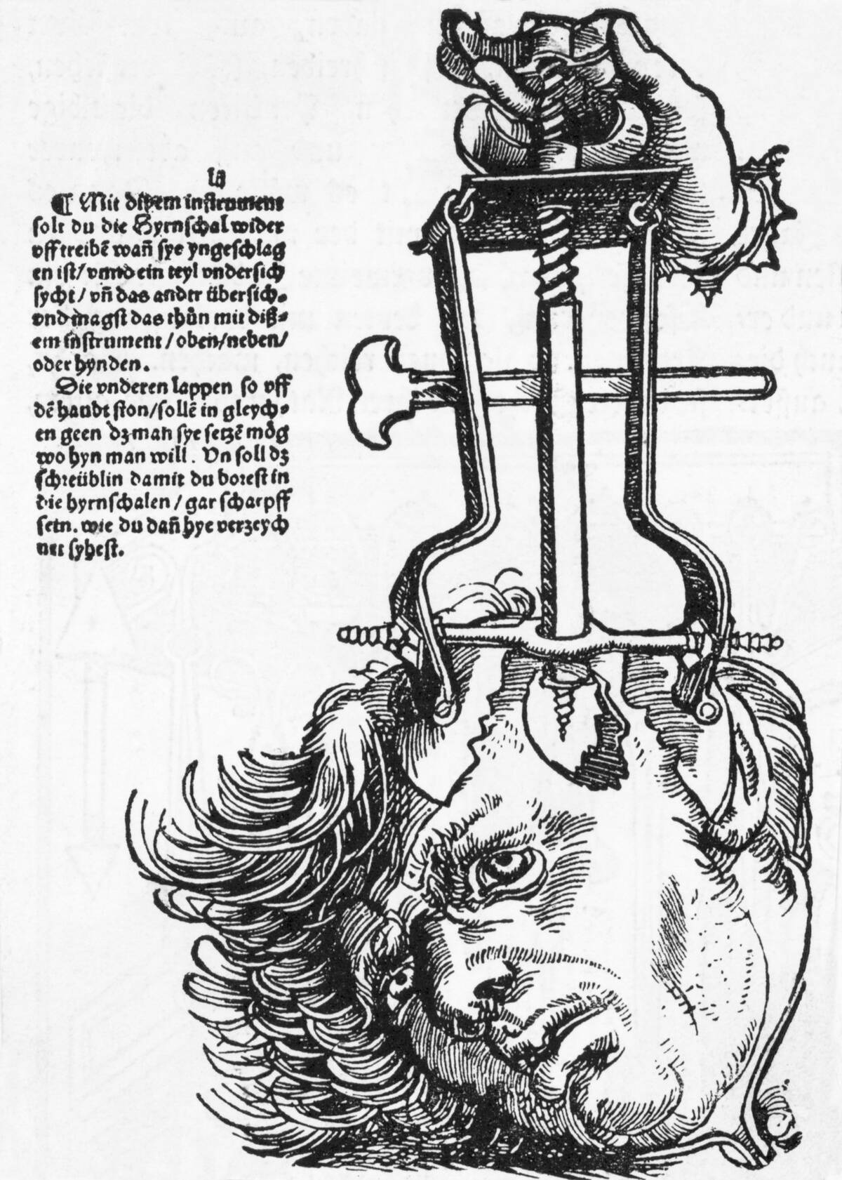 The Trepanation of the Skull. After a woodcut by Gerrssdorf's field book of surgery. Undated.