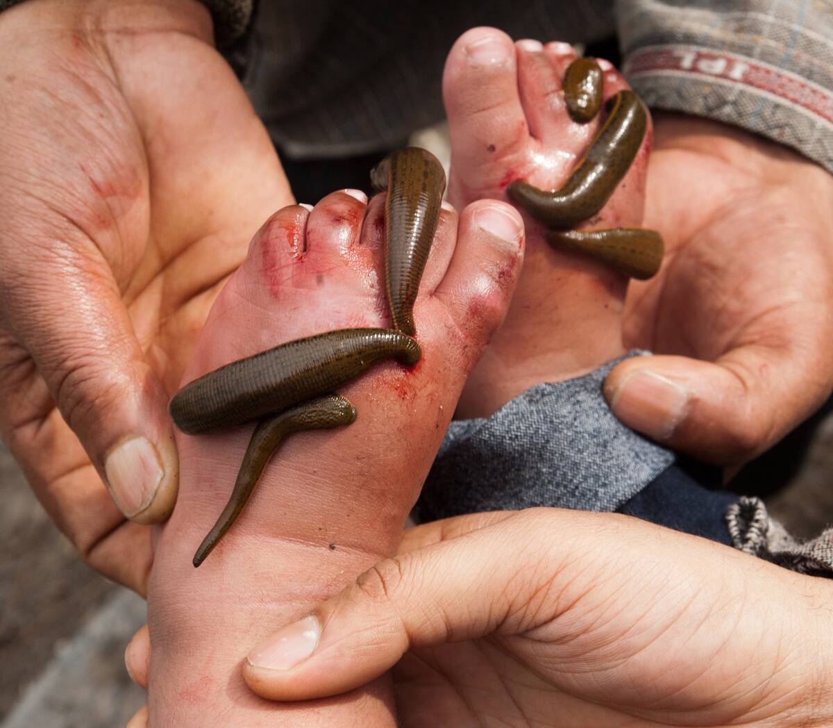 On Nowruz, Patients In Kashmir Go For Leech Therapy