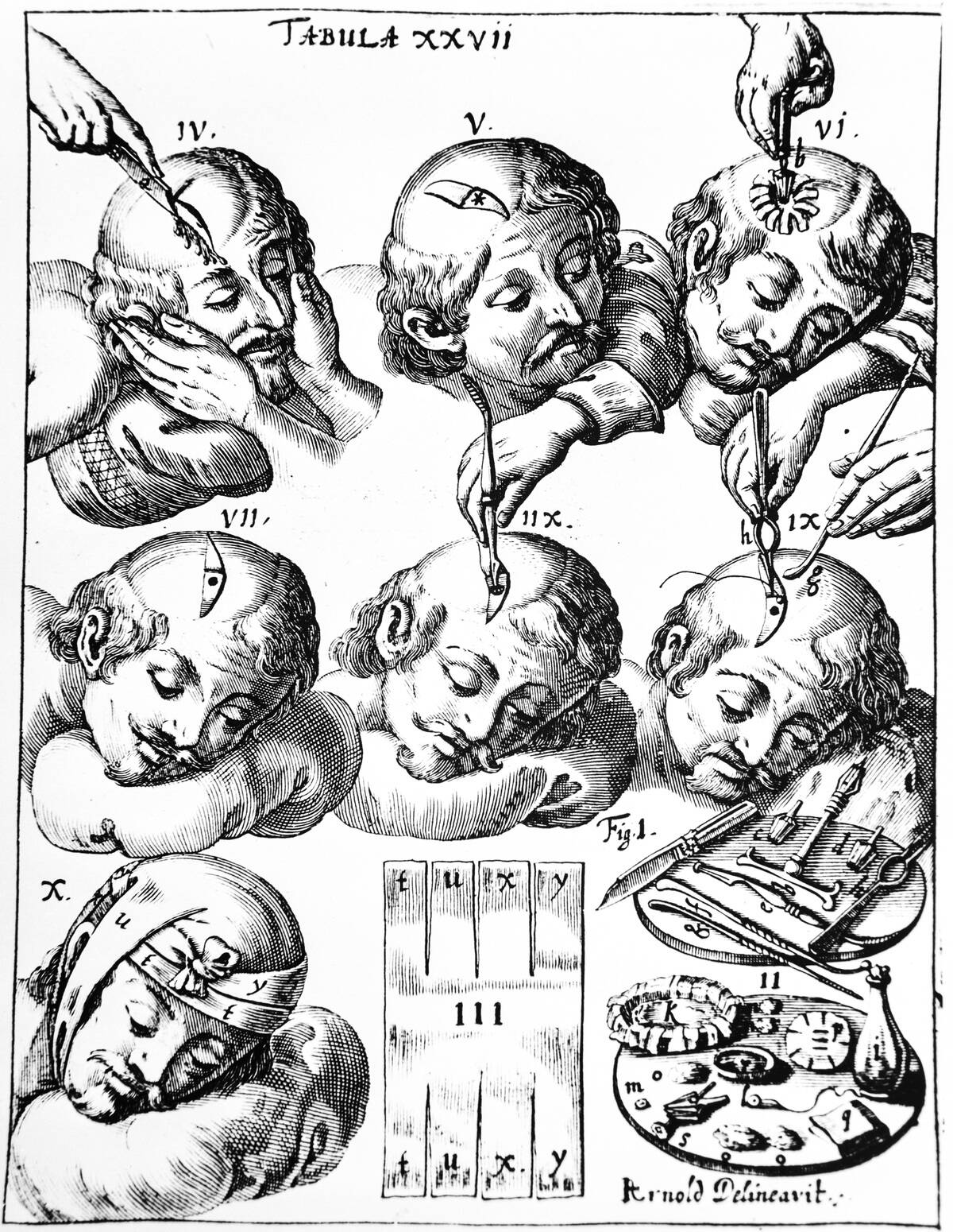 Opération chirurgicale de trépanation