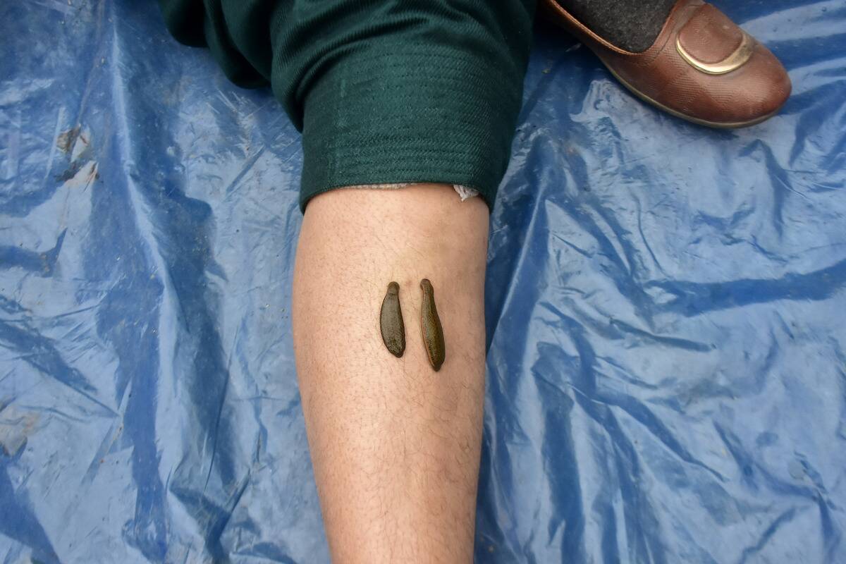 Leech Therapy In Kashmir