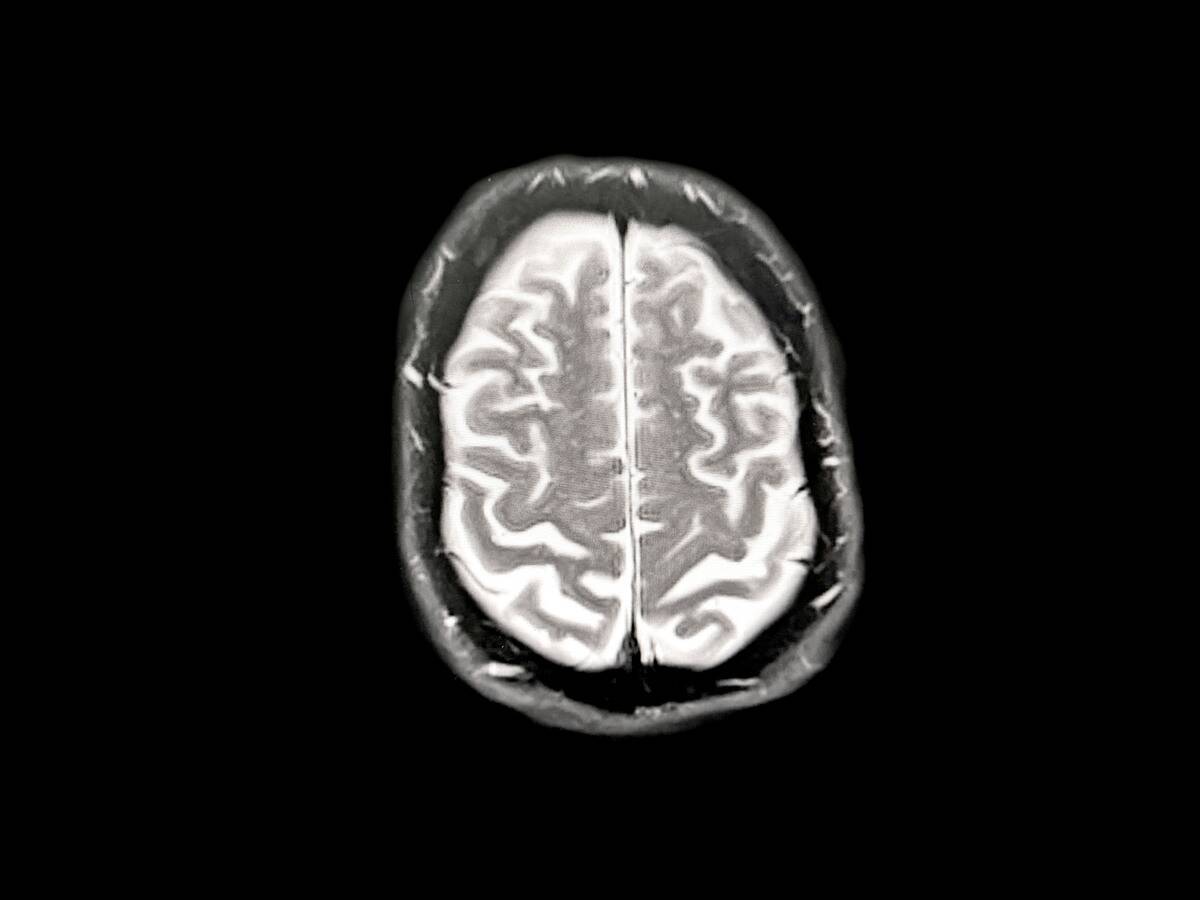 MIR Brain Scan Showing Early Dementia/Alzheimer's